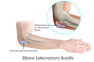 Ð ÐµÐ·ÑÐ»ÑÐ°Ñ Ñ Ð¸Ð·Ð¾Ð±ÑÐ°Ð¶ÐµÐ½Ð¸Ðµ Ð·Ð° bursitis elbow 3D