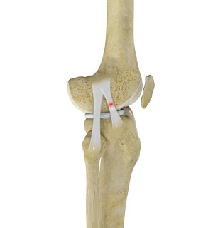 Knee Sprain 