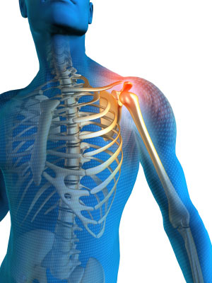 Thoracic Outlet Syndrome