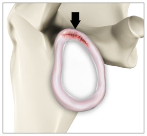 SLAP (Labral) tears