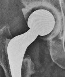Causes of Joint Replacement Failure