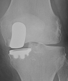 Exploring Customized Treatment for Knee Replacement