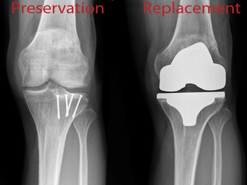 Joint Preservation vs. Replacement