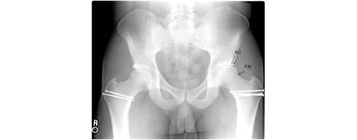 hip-preservation