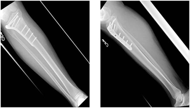 osteotomies-knee