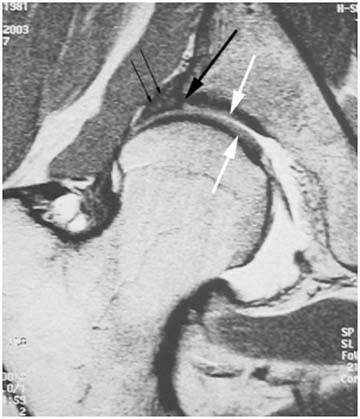 periacetabular-osteotomy-1