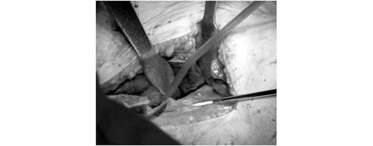 periacetabular-osteotomy