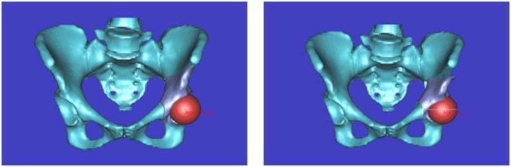 periacetabular-osteotomy-1