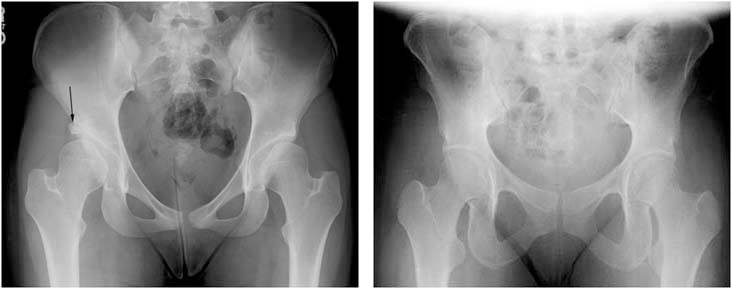 periacetabular-osteotomy