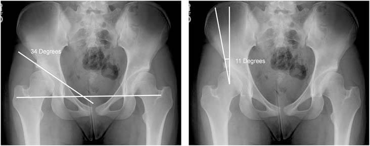 periacetabular-osteotomy