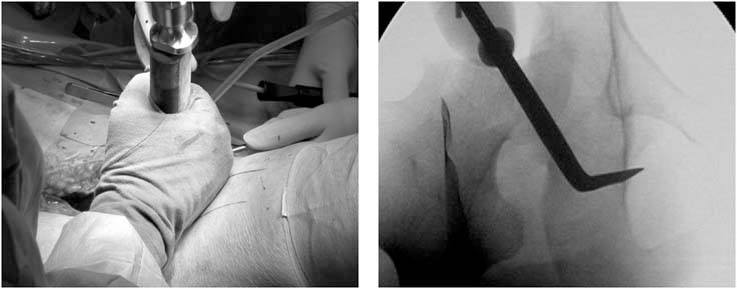 periacetabular-osteotomy