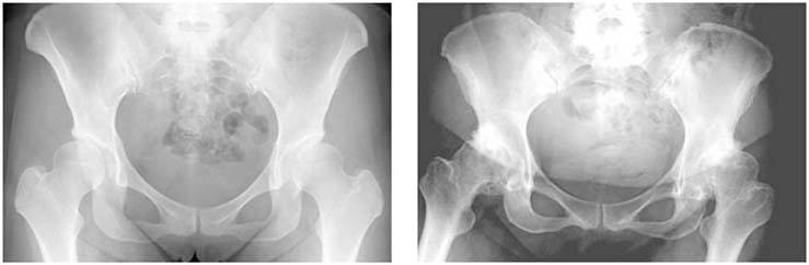 periacetabular-osteotomy